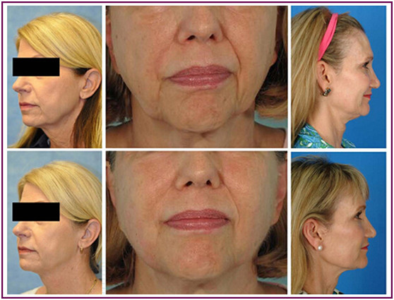 0.1 - 2.5J Skin Lifting Skin rejuvenation Machine HIFU Machine With Changeble Spot Size