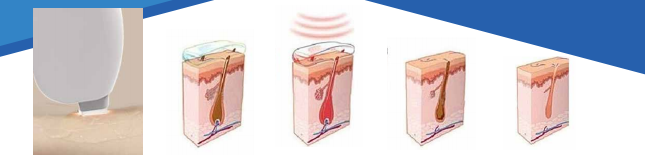Europe welcomed 12*20 mm big light spotlaser hair deplication 808nm hair removal diodenlaser