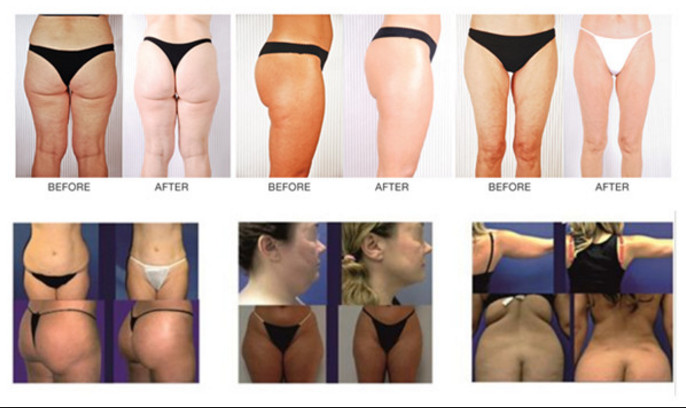 Bipolar Ultrasonic Cavitation Rf Slimming Machine , Body Cavitation Weight Loss Machine