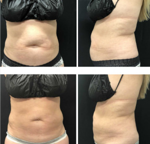 Portable 5MHz 650nm Cryolipolysis Fat Freeze Slimming Machine