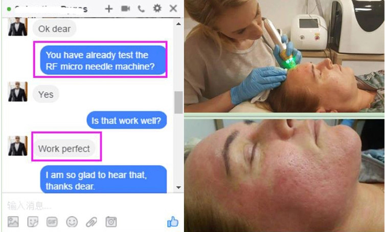 stretch mark removal rf fractional rf microneedle machine