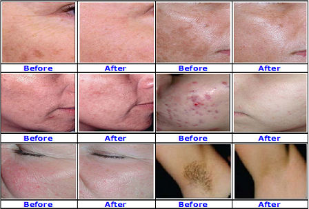 Fast selling ipl shr machine: hair removal & skin rejuvenation IPL machine