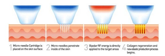 rf microneedle face lifting.jpg