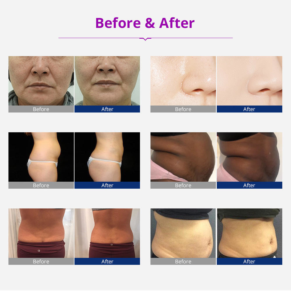 635nm 650nm Lipo Laser Slimming Machine 40K 6 In 1 RF Ultrasonic Cavitation