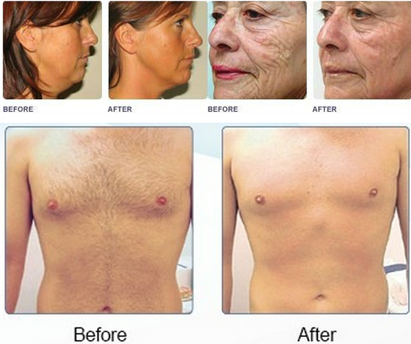 Beauty salon skin rejuvenation ipl hair removal vertical
