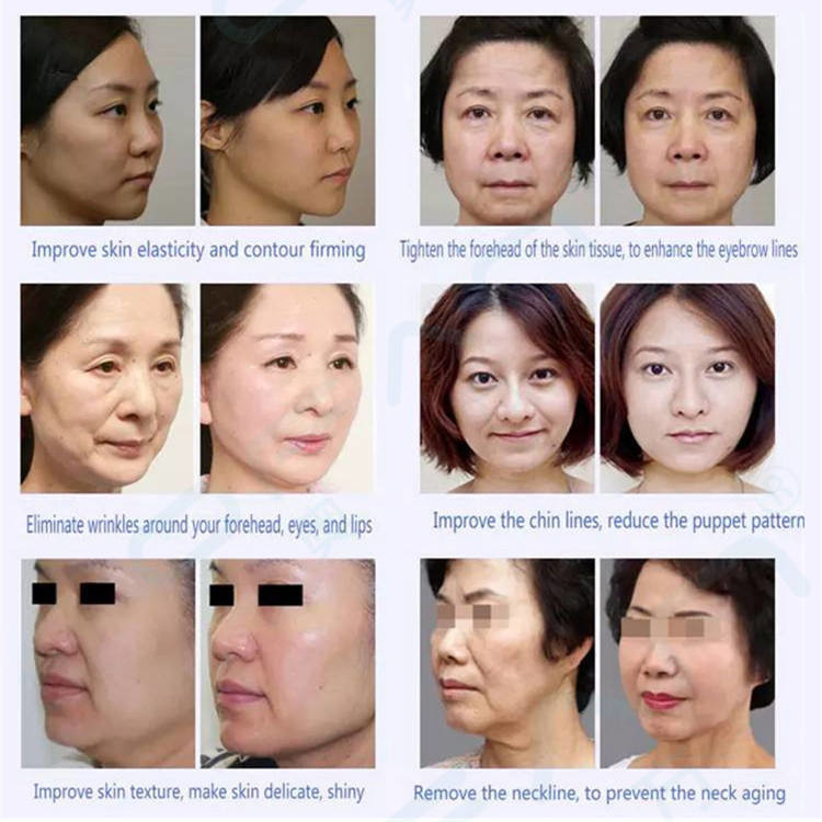 Rf Beauty Equipment For Face Household Beauty Skin Care And Freckle Radio Frequency Beauty Instrument