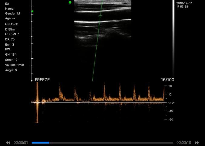 Wifi Color Doppler Handheld Ultrasound Scanner Linear And Convex Connected To Mobilephone Android iOS Windows Supported 5