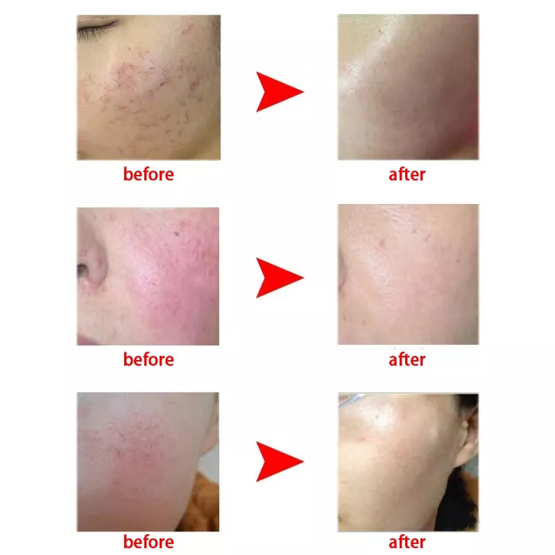 Vascular Spots Varicose Veins Removal Machine RF 980nm Diode Laser