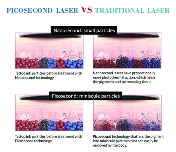 Nd Yag Picosecond Laser Machine 532nm 1064nm 755nm
