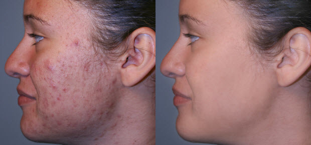 cpt skin rejuvenation machine fractional microneedle radiofrequency