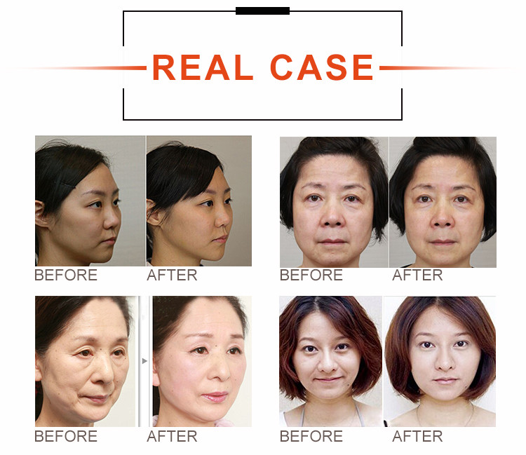 Professional Home HiFu Beauty Machine Skin Tightening device 4Mhz-10Mhz