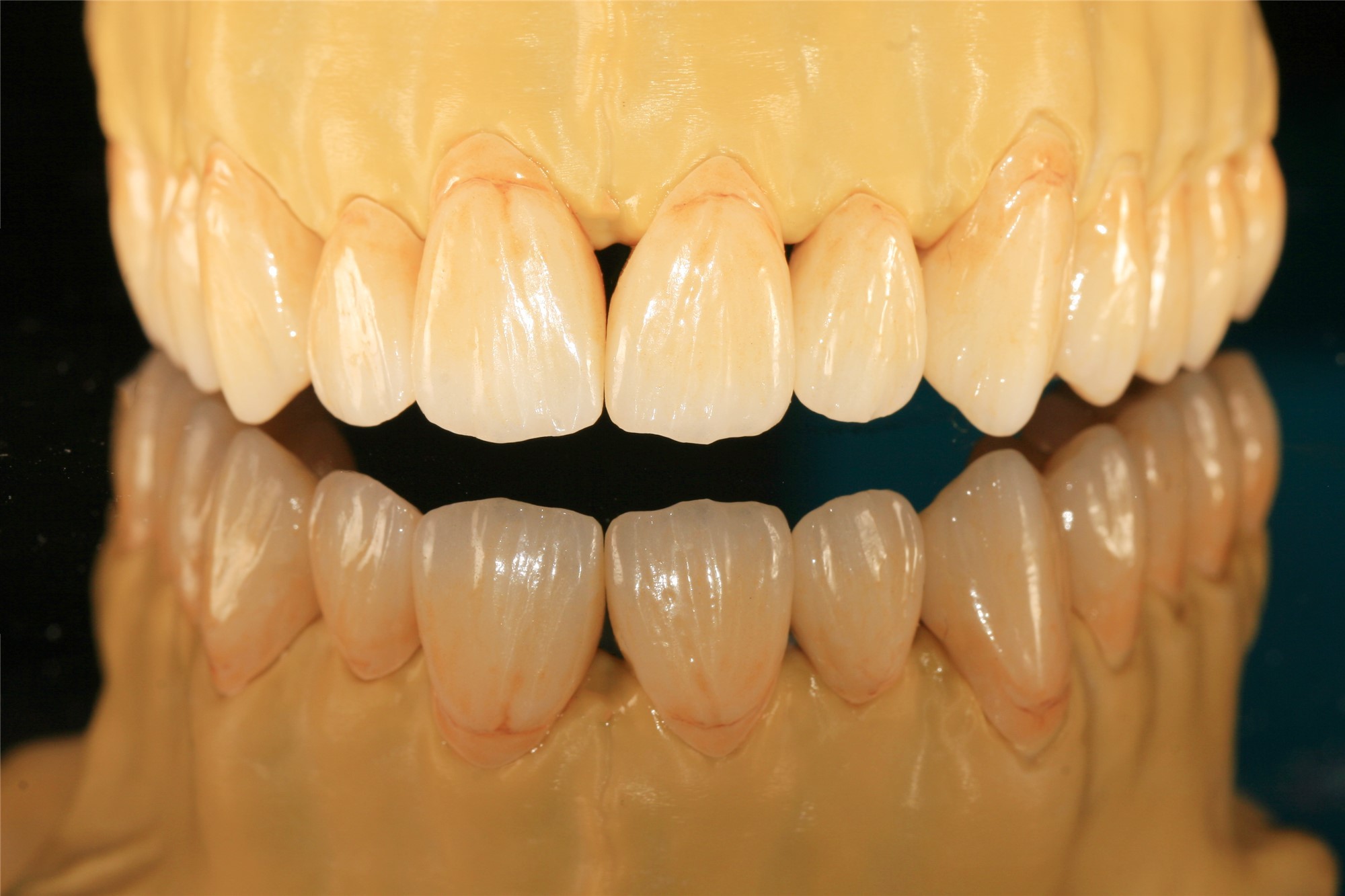 Design Dental Lab Monolithic Zirconia Dental Crown For Molars Posterior Teeth
