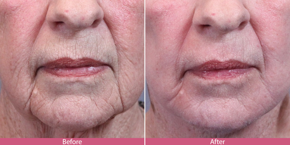 Protable Fractional Co2 Laser Treatment Machine For Skin Resurfacing / Wrinkles