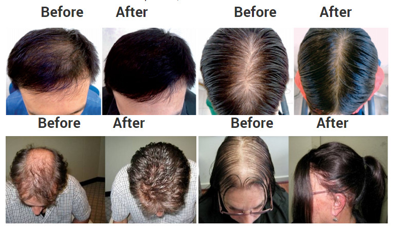 272 laser diodes Hair Regrowth Laser Cap & Helmets For Treating Hair Loss At Home