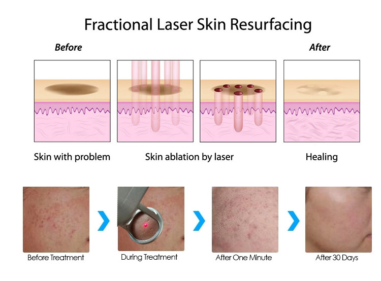 Resurfacing CO2 Fractional Laser Machine 10600nm Uneven Skin Tone Fix