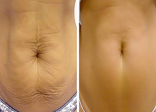 Fractional Co2 Laser Skin Resurfacing Machine For Stretch Marks Elimination