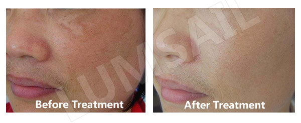 Facial Treatment LED Phototherapy Machine , Acne Light Therapy Devices
