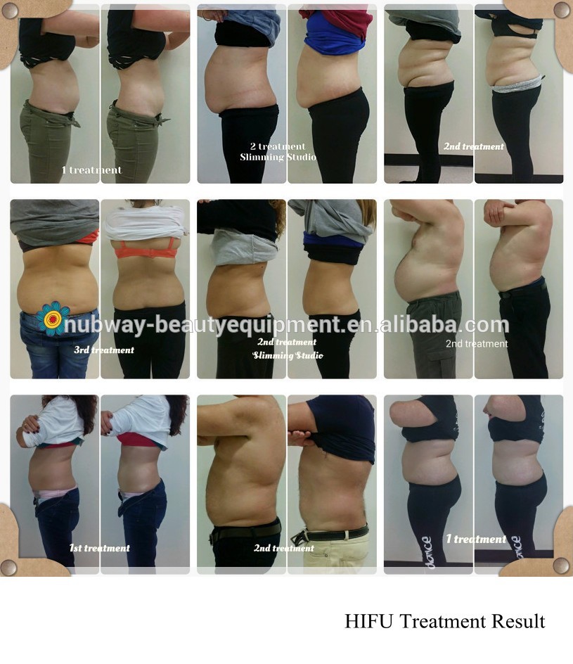 HIFU body slimming treatment RESULT.jpg