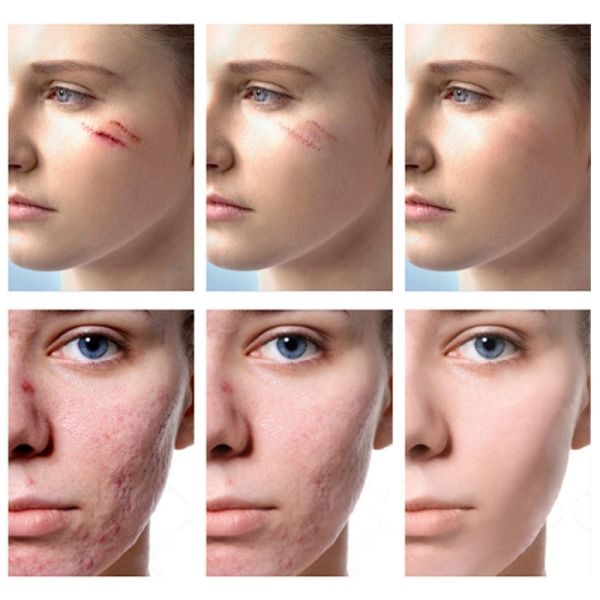 Scar repair cream, continued use will prevent scarring.