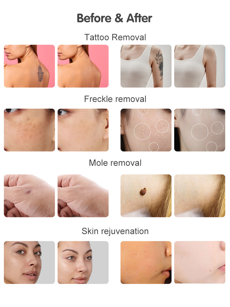 NIR Milk Light Whitening Ice 808nm Diode Laser Device 4 Wavelength 755 808 940 1064 Diode Laser Hair Removal Machine