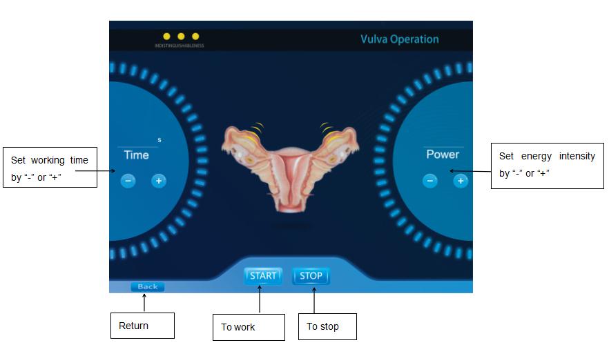 2 in 1 female intimate areal Tigthen RF Radio Frequency Technology Labia Tighten Rejuvenation Device