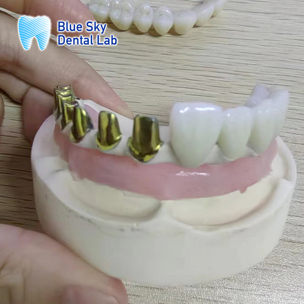 Full Arch Dental Implant Cases Compatible With Multiple Implant Systems