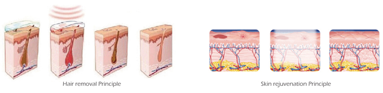 The Professional Shr Best Hair Removal Ipl Elight Opt Laser Machine