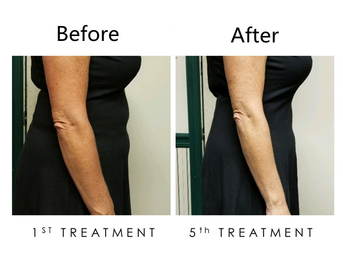 360 Degree Cryolipolysis Coolsculpting Machine Aesthetics Slimming