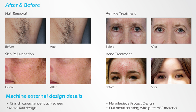 ipl shr treatment before and after