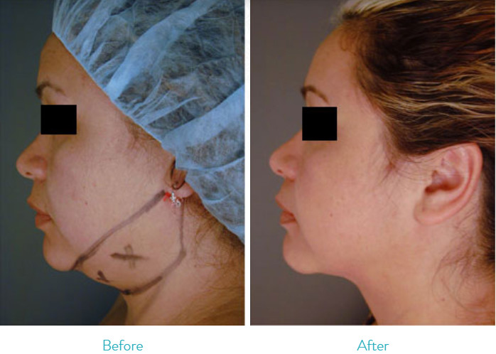 All In One Plastic Surgery Lipo Slimming Machine For Neck / Chin / Arm Fat Removal
