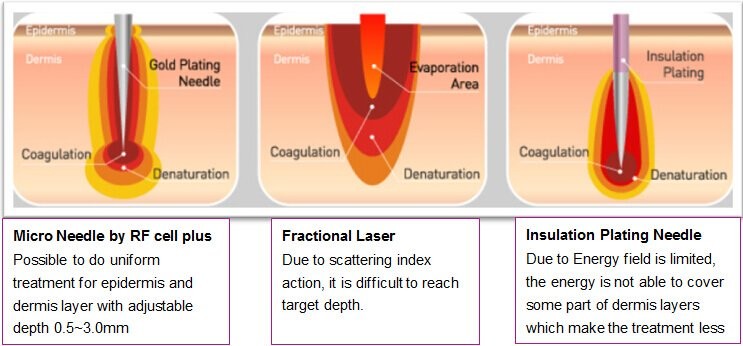 Stretch Mark Rf Fractional Machine Iso Approved