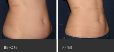 Fat Burning Cryolipolysis Fat Freeze Slimming Machine , Fat Cavitation Machine For Men Women