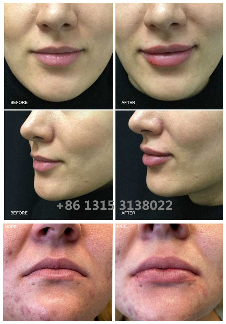 Allergan Juvederm Dermal Filler Injection Ultra4 With Lidocaine