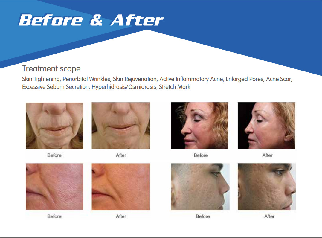 Skin maintenance micro needle nurse system secret microneedle fractional rf laser