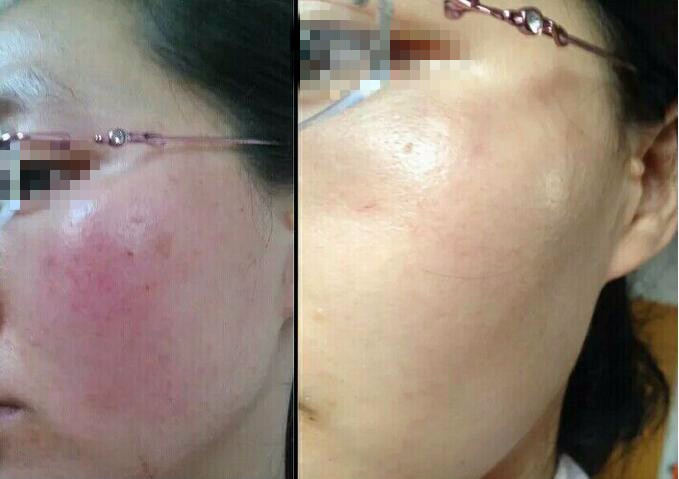 Skin Rejuvenation Spider Vein Treatment Machine , Adjustable Laser Vein Removal Machine
