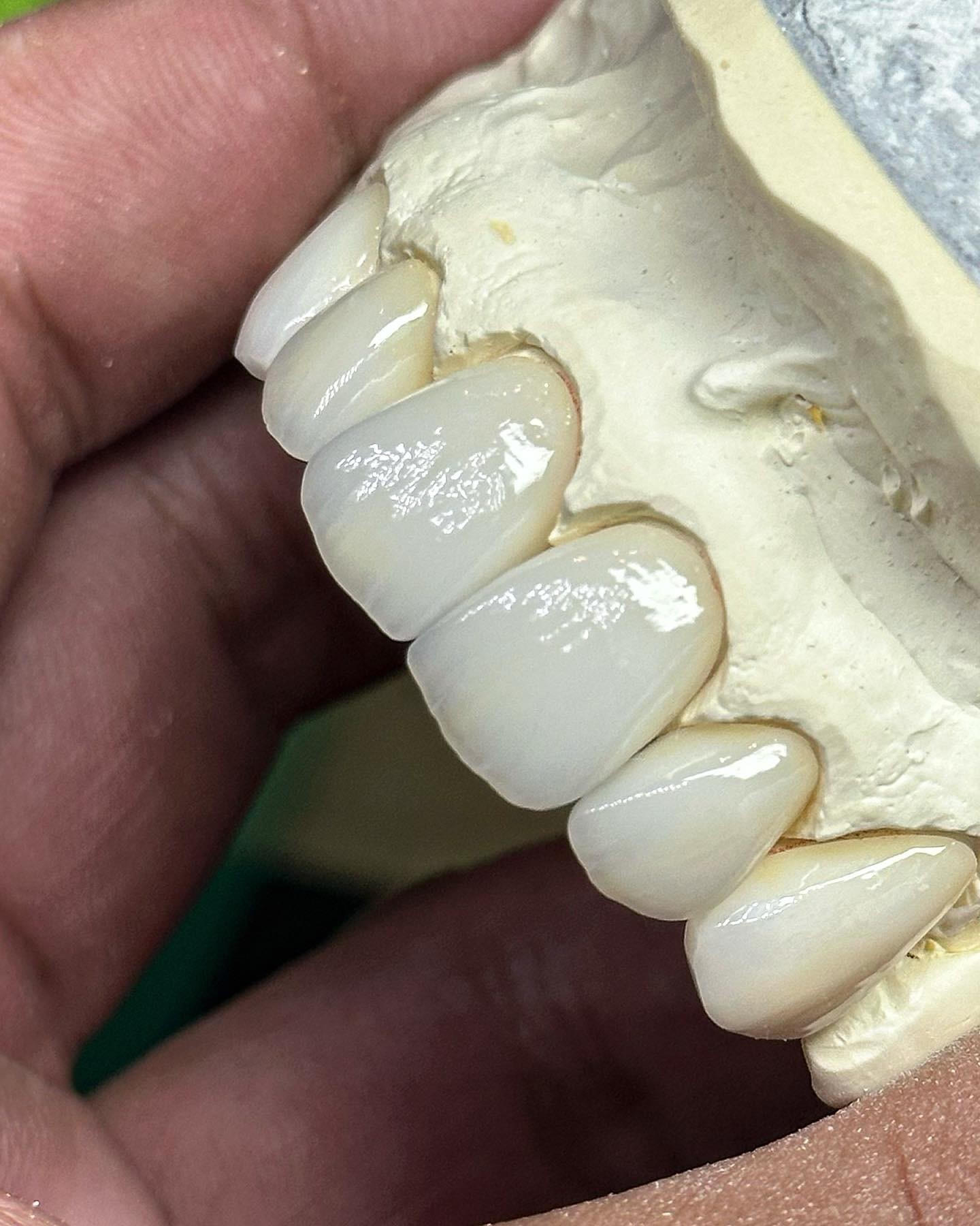 Transluency Layered Zirconia Crown for Optimal Functionality and Natural Aesthetics