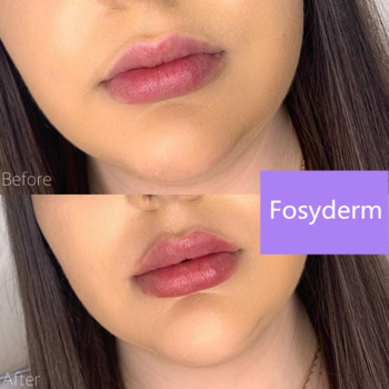 Hialuronato De Sodio Gel Volume Hyaluronic Dermal Filler For Lip Injections