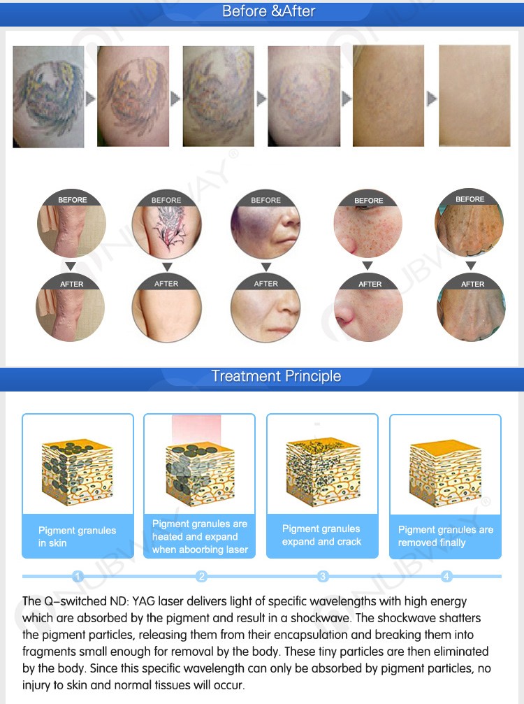 1064nm 532nm and 1320nm 3 wavelength tattoo removal nd yag laser machine
