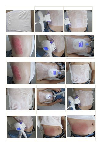 Cool Sculpting Slimming Cryolipolysis Machine for Freezing Fat