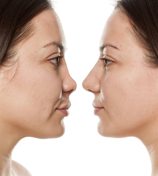 Fosyderm 2ml Deep Hyaluronic Acid Filler Injections For Shaping