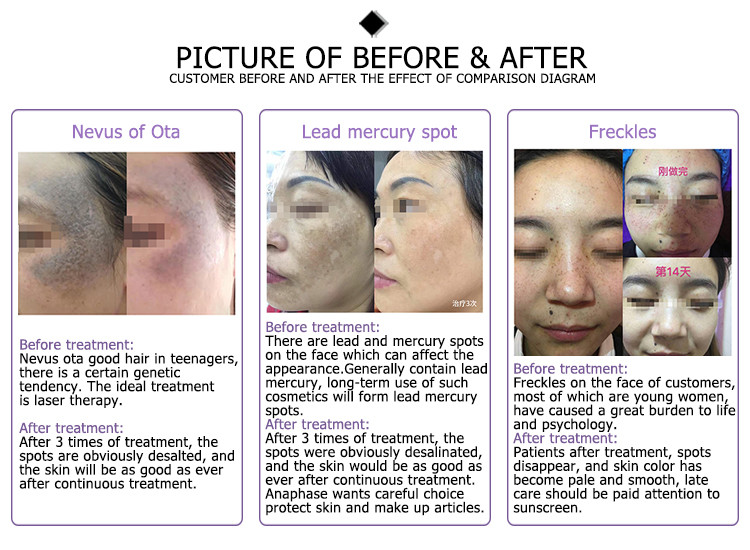pigment removal korean brand multifunctional maquina ps discovery pico laser for melasma