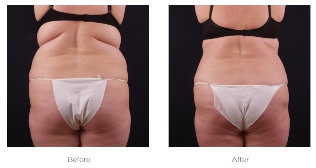Elite Ultra 360_Before_and_AFter_Abdomen