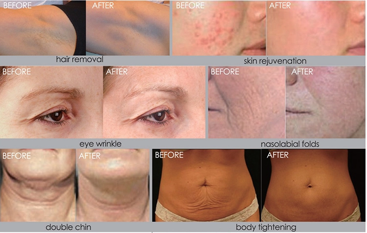 Tattoo Removal Rf Salon Beauty Machine 1 - 10HZ Frequency CE Certification
