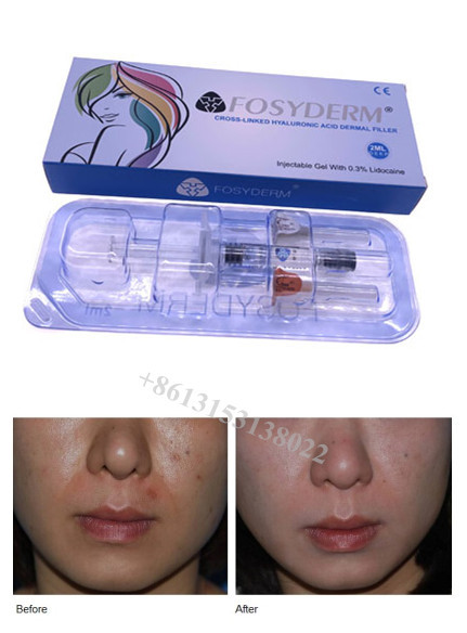 Hyaluronic Acid Gel Dermal Filler For Lips Wrinkle Filler