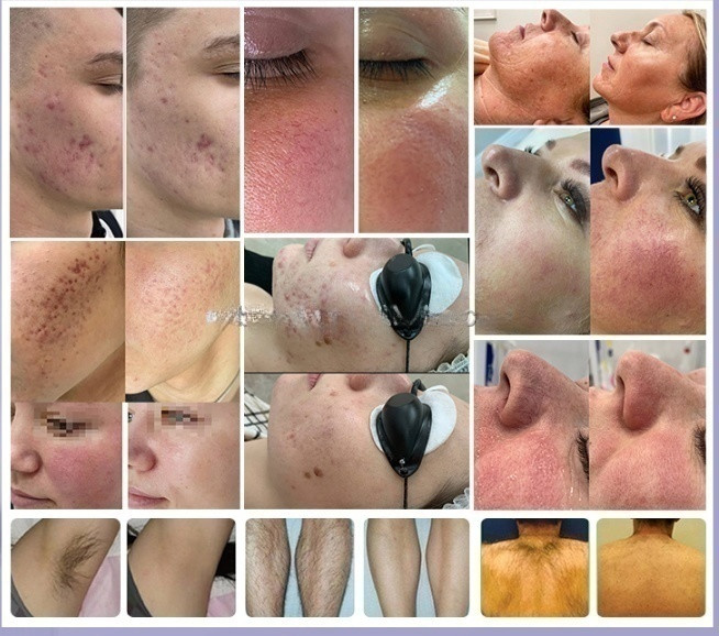 CE ISO Laser Multifunction Beauty Machine M22 IPL Hair Removal Skin Rejuvenation Machine