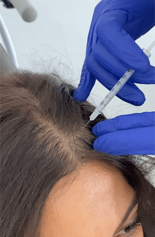 Original Anti Hair Loss Injection Treatment Hair Regrowth Essence Alopecia Areata Mesotherapy Serum For Hair