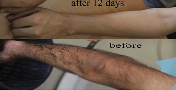 New portable 808nm diode laser photo epilator beauty machine