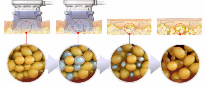 Fat Freezing Machine For Fat Reduction With Kryolipolyse Coolplas 0