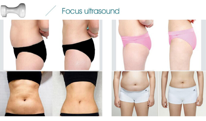 hot sale mini slimming machine with HIFU and RF and ultrasound cavitation technology for obesity cure and face lift