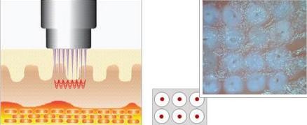 cpt skin rejuvenation machine fractional microneedle radiofrequency